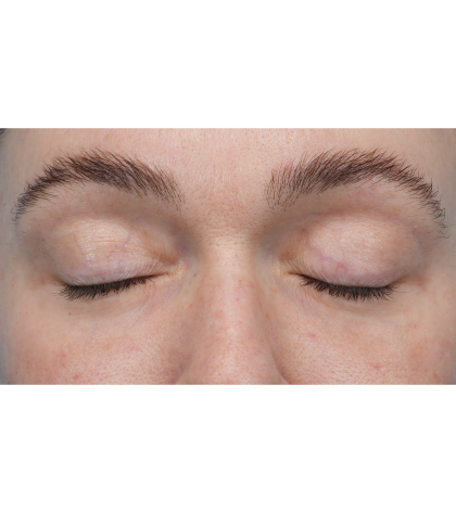 CO2 Laser Resurfacing Before & After Patient #3400