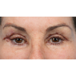Revision Blepharoplasty Before & After Patient #3418