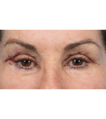 Revision Blepharoplasty Before & After Patient #3418