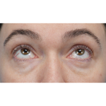 CO2 Laser Resurfacing Before & After Patient #3400