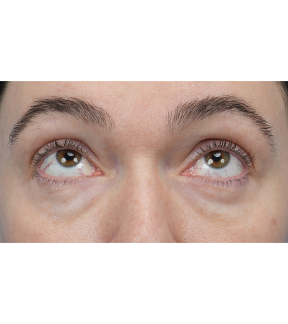 CO2 Laser Resurfacing Before & After Patient #3400