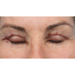 Revision Blepharoplasty Before & After Patient #3418