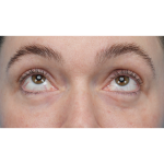 CO2 Laser Resurfacing Before & After Patient #3400