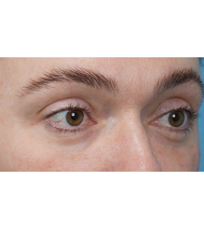 CO2 Laser Resurfacing Before & After Patient #3400