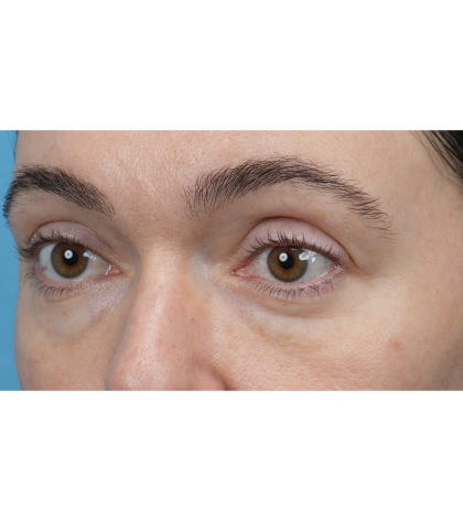 CO2 Laser Resurfacing Before & After Patient #3400