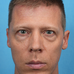 Lower Blepharoplasty Before & After Patient #3467
