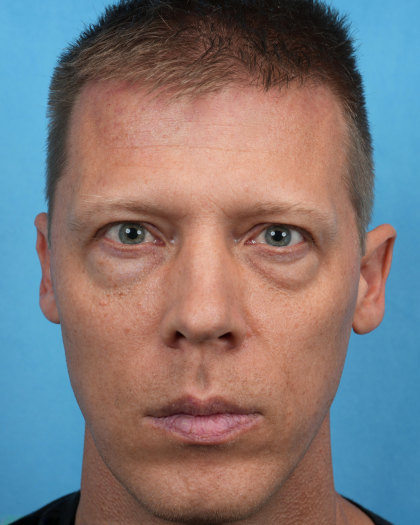 Lower Blepharoplasty Before & After Patient #3467