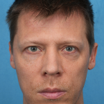 Lower Blepharoplasty Before & After Patient #3467
