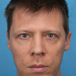 Lower Blepharoplasty Before & After Patient #3467