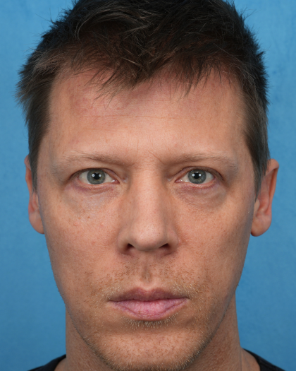 Lower Blepharoplasty Before & After Patient #3467