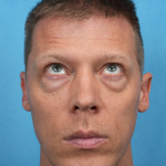Lower Blepharoplasty Before & After Patient #3467