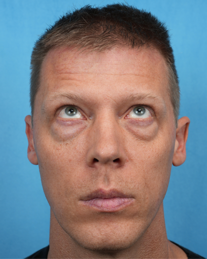 Lower Blepharoplasty Before & After Patient #3467