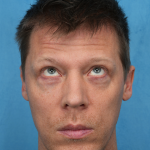 Lower Blepharoplasty Before & After Patient #3467