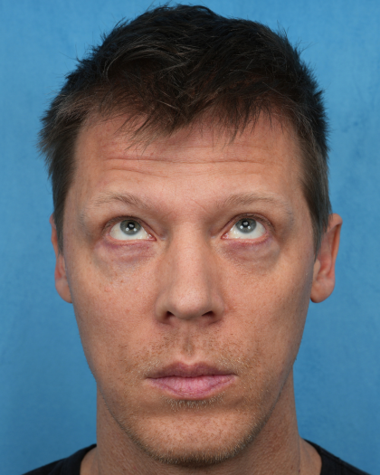 Lower Blepharoplasty Before & After Patient #3467