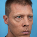 Lower Blepharoplasty Before & After Patient #3467