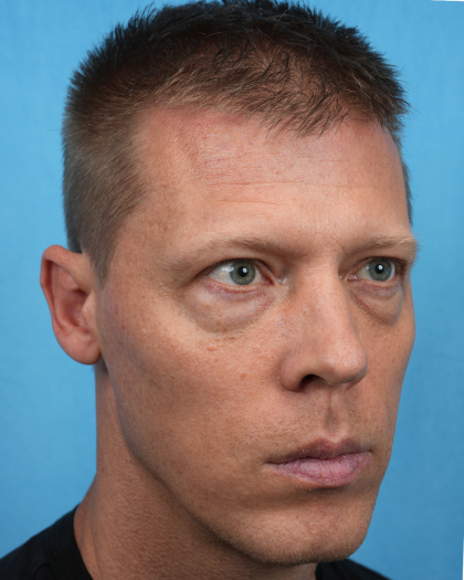 Lower Blepharoplasty Before & After Patient #3467