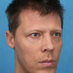 Lower Blepharoplasty Before & After Patient #3467