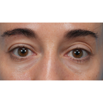 CO2 Laser Resurfacing Before & After Patient #3533