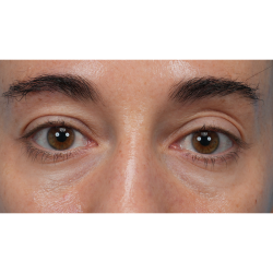 CO2 Laser Resurfacing Before & After Patient #3533