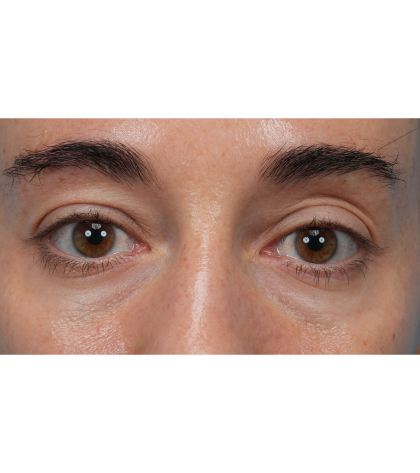 CO2 Laser Resurfacing Before & After Patient #3533