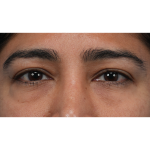 Lower Blepharoplasty Before & After Patient #3521