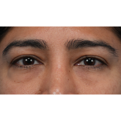 Lower Blepharoplasty Before & After Patient #3521