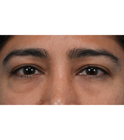 Lower Blepharoplasty Before & After Patient #3521