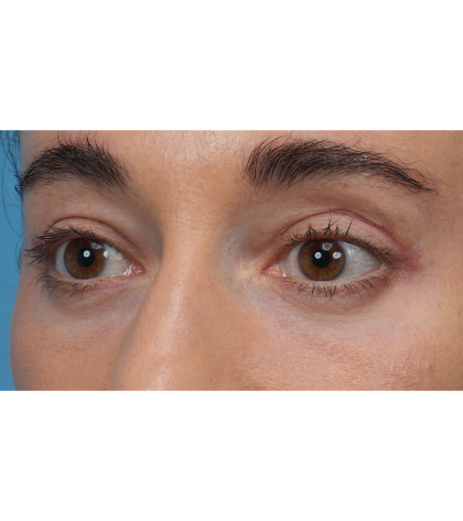 CO2 Laser Resurfacing Before & After Patient #3533