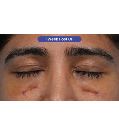 Lower Blepharoplasty Before & After Patient #3521