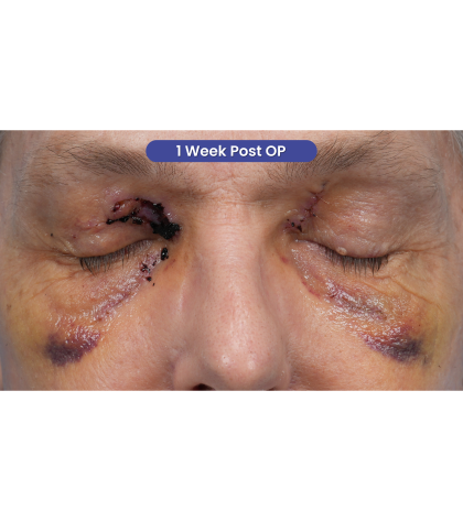 Lesion Removal Before & After Patient #3484