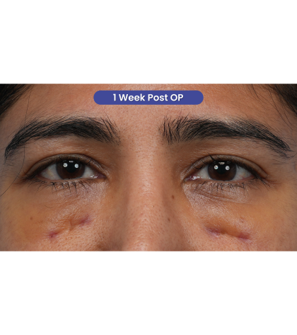 CO2 Laser Resurfacing Before & After Patient #3533