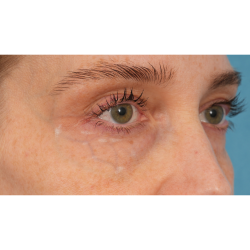 Vein Removal Before & After Patient #3437