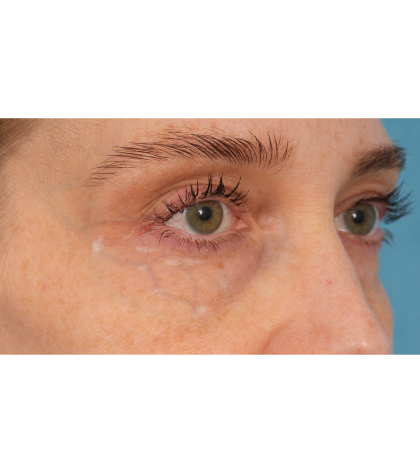 Vein Removal Before & After Patient #3437