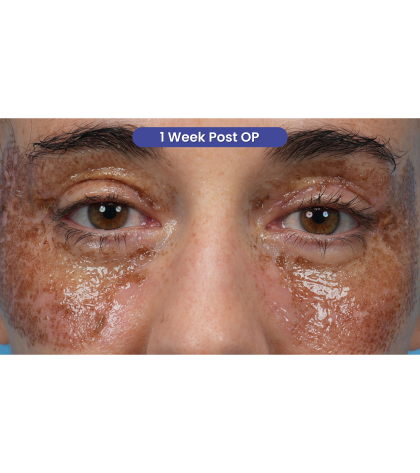 CO2 Laser Resurfacing Before & After Patient #3533
