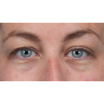 Upper Blepharoplasty Before & After Patient #3495
