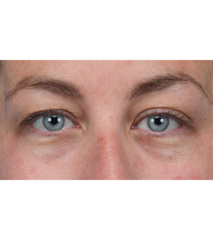 Upper Blepharoplasty Before & After Patient #3495