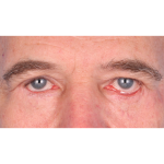 Revision Blepharoplasty Before & After Patient #3458