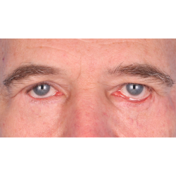 Revision Blepharoplasty Before & After Patient #3458
