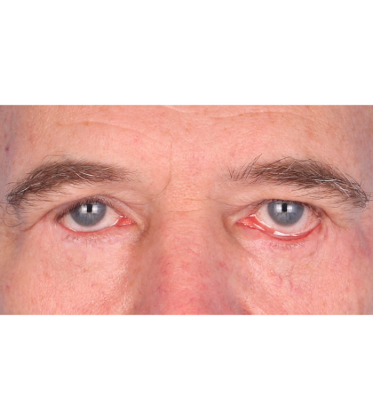 Revision Blepharoplasty Before & After Patient #3458