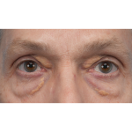 Lesion Removal Before & After Patient #3484