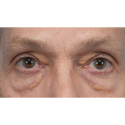 Lesion Removal Before & After Patient #3484