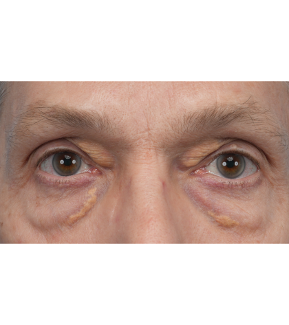 Lesion Removal Before & After Patient #3484