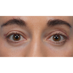 CO2 Laser Resurfacing Before & After Patient #3533