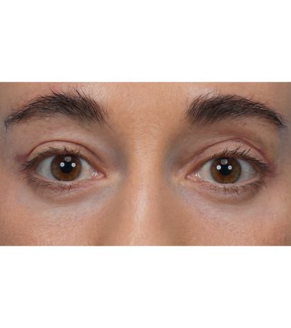 CO2 Laser Resurfacing Before & After Patient #3533