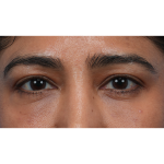 Lower Blepharoplasty Before & After Patient #3521
