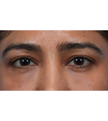 Lower Blepharoplasty Before & After Patient #3521
