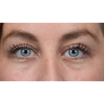 Upper Blepharoplasty Before & After Patient #3495
