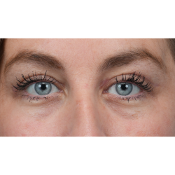 Upper Blepharoplasty Before & After Patient #3495