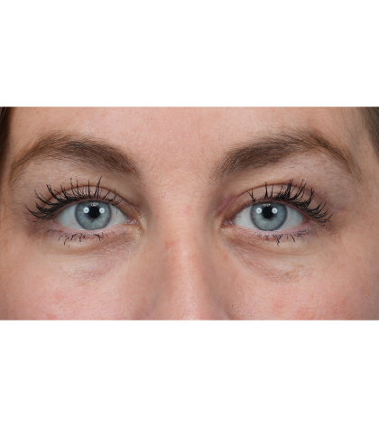 Upper Blepharoplasty Before & After Patient #3495