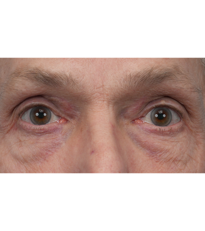 Lesion Removal Before & After Patient #3484
